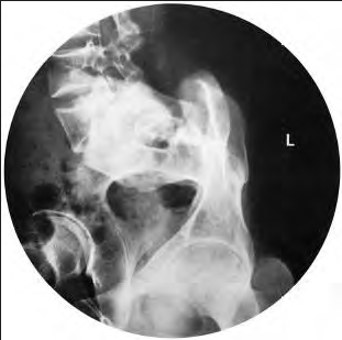 <p>Ilium post obl alternative </p>