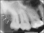 <p>Maxillary tuberosity (posterior rounded area behind maxillary molars)</p>
