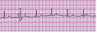<p>What does this EKG indicate? </p>