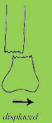 <p>bone breaks in 2 or more parts, ends move so they do not line up</p>