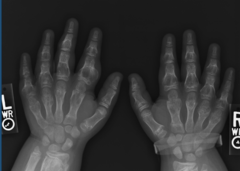<p>What is this?</p><p>- 10-30 yo</p><p>- No pain until trauma</p>