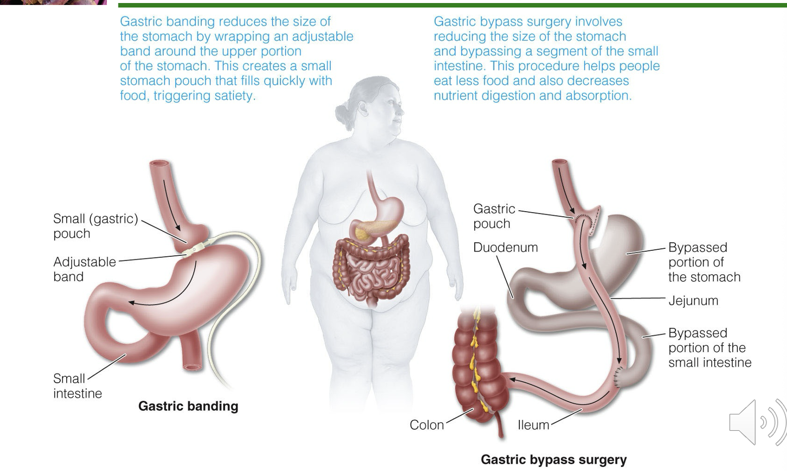 <p>reduces the size of the stomach and bypasses a segment of the small intestine. This procedure helps people eat less food and also decreases nutrient absorption</p>