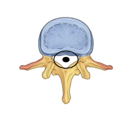 <p><span>large central hole created by the body and arch. (They line up to hold the spinal cord)</span></p>
