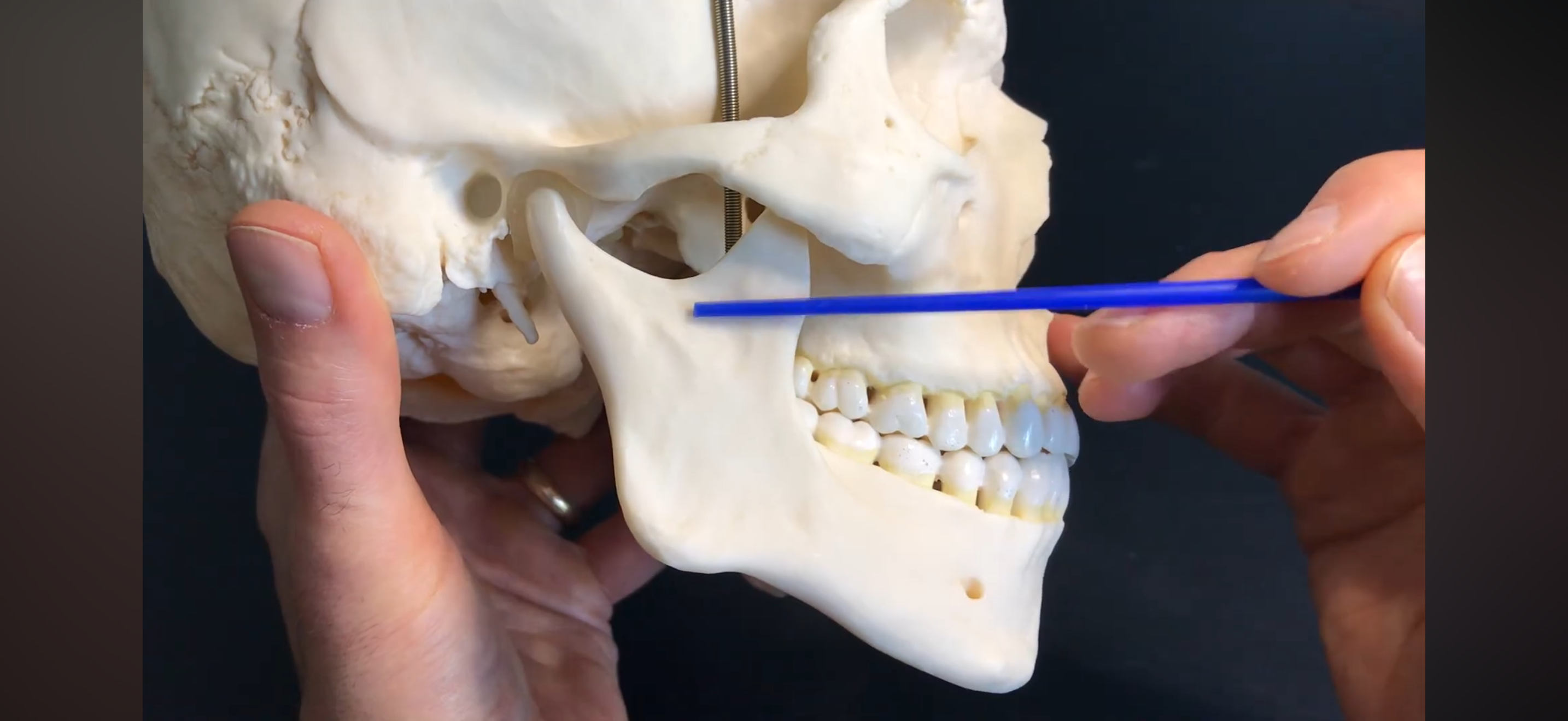 <p>What PART of the mandible is this?</p>