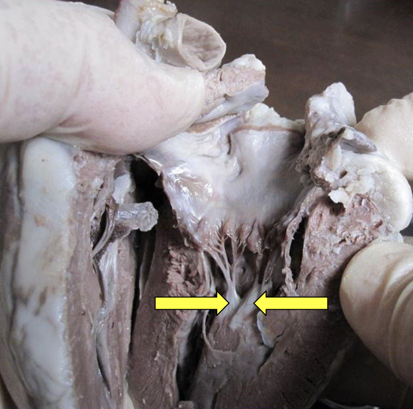 <p>papillary muscle</p>