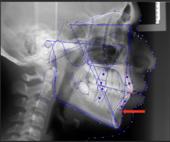 <p>which anatomical landmark:</p><p>- Most posterior point in the concavity along the anterior border of the symphysis</p>