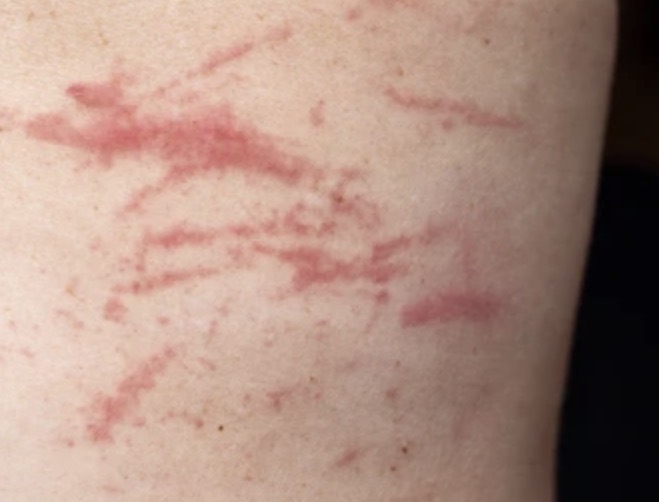 <ul><li><p>Secondary Skin Lesion</p></li><li><p>Self-inflicted excoriation usually from scratching</p></li><li><p>skin picking</p></li></ul><p></p>
