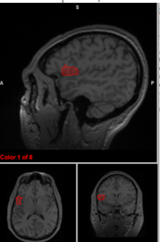 <p>Broca’s Area</p>