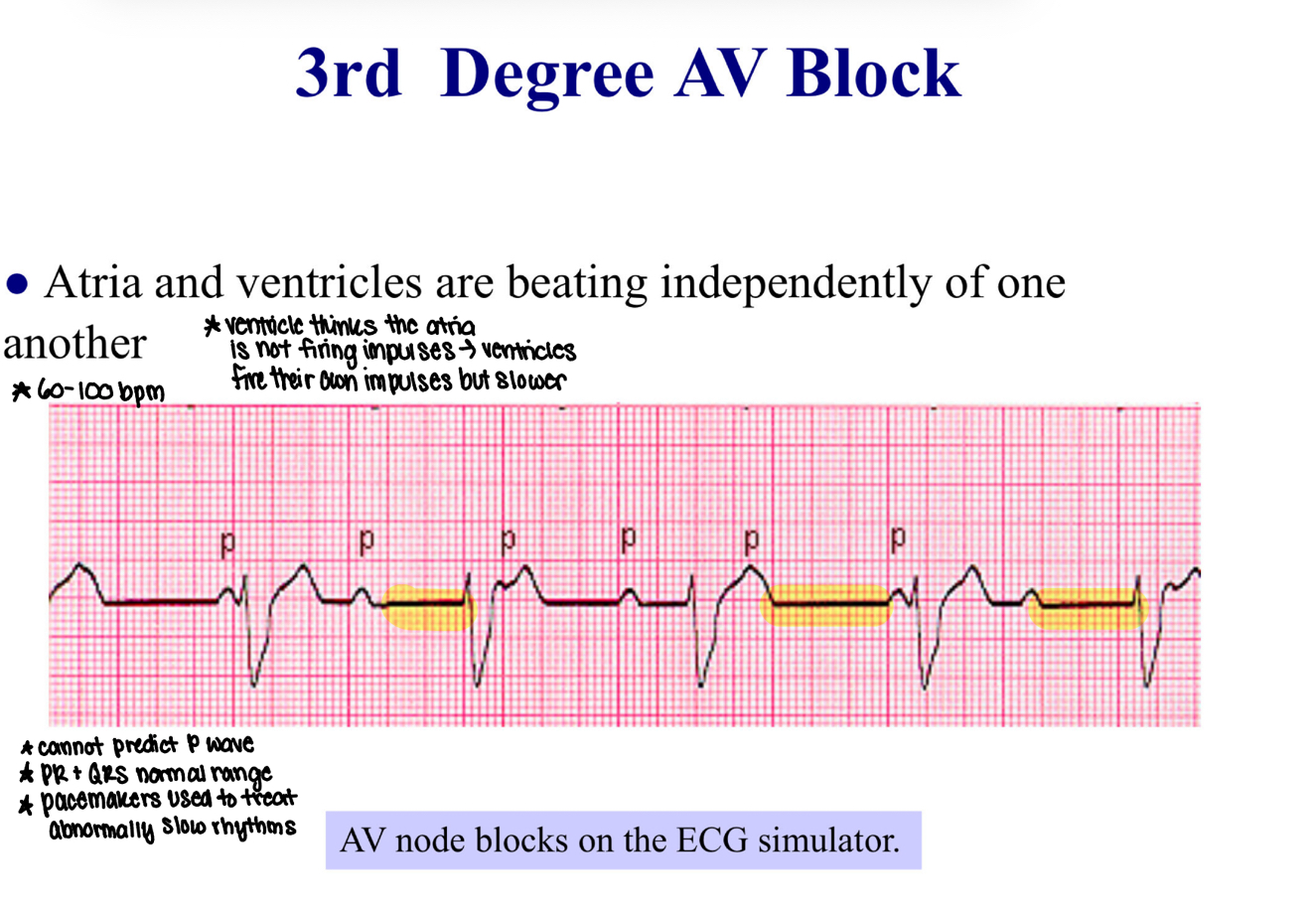 <p><strong>3rd Degree AV Block</strong></p><p></p>