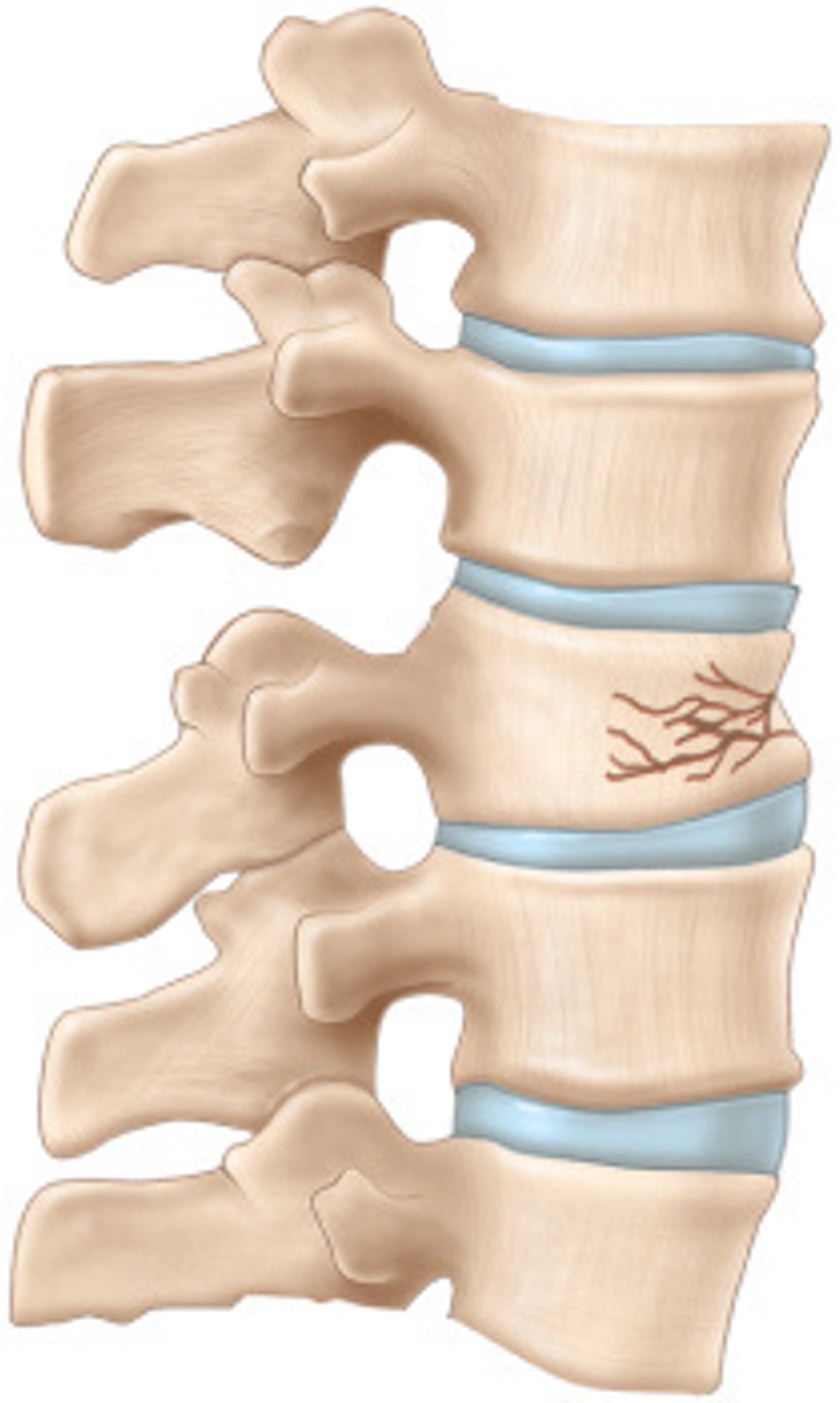 <p>bone is crushed or collapses into small pieces</p>