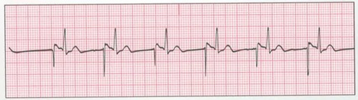 <p>howd yk this is a pacemaker rhythm</p>
