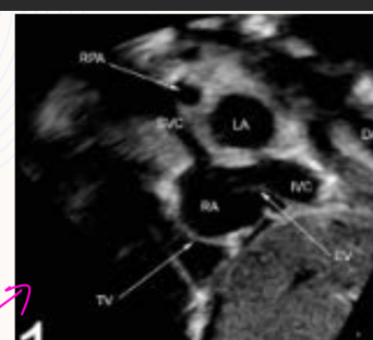 <p>Bicaval, and A4C best place to spot VSD and PFO</p>