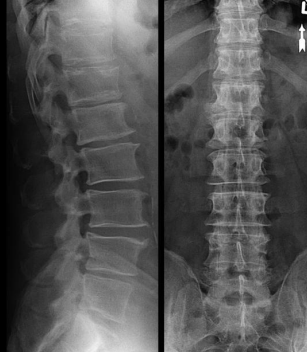 <p>Transitional Vertebrae</p>