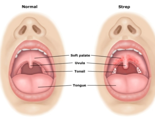 <p>Caused by <strong>Streptococcus pyogenes</strong></p><p>Group A <strong>(Lancefield classification)</strong></p><p>Beta-hemolytic</p><p><strong>spreads through respiratory droplets</strong></p><p><strong>Virulence factors</strong></p><p>Capsule</p><p>Pili</p><p><strong>Symptoms </strong>include high fever, inflamed pharynx, coughing, swollen lymph nodes in neck, and swollen tonsils.</p><p>The organism secretes toxin that damages pharyngeal cells.</p><p>Recovery is hastened by antibiotics.</p><ul><li><p><strong>Scarlet fever</strong> is strep throat with a rash.</p></li></ul><p>Rash caused by <strong>erythrogenic toxins.</strong></p><p>Toxins cause bleeding in the skin.</p><ul><li><p><strong>Rheumatic fever</strong> is a serious complication.</p></li></ul><p>Fever and pain</p><p>Heart tissue inflammation</p><p>Heart valve damage</p><p><strong>A hemolytic reaction especially beta is a complete break down of red blood cells. </strong></p>