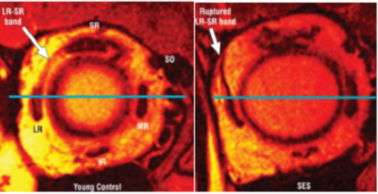 <p>a bilateral divergence insufficiency esotropia greater at distance (12 PD) than near (5 PD) typically in patients >70 yo due to degeneration of connective tissue and sagging of the lateral rectus. A small vertical deviation and bilateral blepharoptosis are also common.</p>
