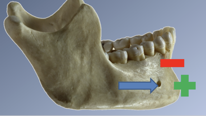 <p>Mandibular growth</p>