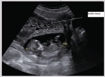 <p><span style="background-color: transparent;">Similar to partial mole but with viable and complete fetal tissue</span></p>