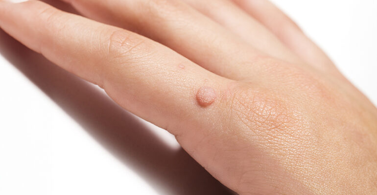 <p>A benign skin growth caused by human papillomavirus (HPV), commonly known as a wart. </p>