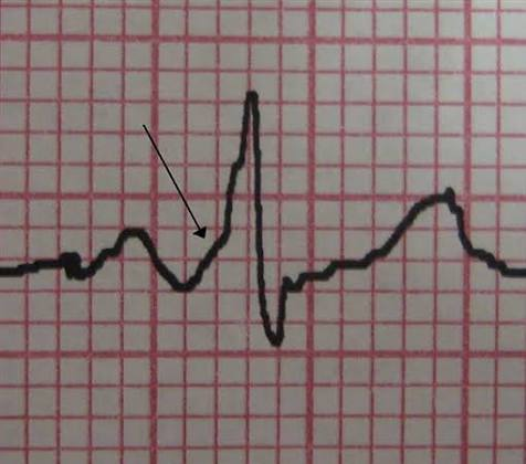 <p>Wolff-Parkinson-White Syndrome</p><p><sub>(</sub><strong><sub>WPW = “Wolf takes a shortcut”</sub></strong><sub> → Bundle of Kent bypasses the AV node → ventricles activate </sub><strong><sub>too early</sub></strong><sub> → </sub><strong><sub>short PR + delta wave</sub></strong><sub>.)</sub></p>