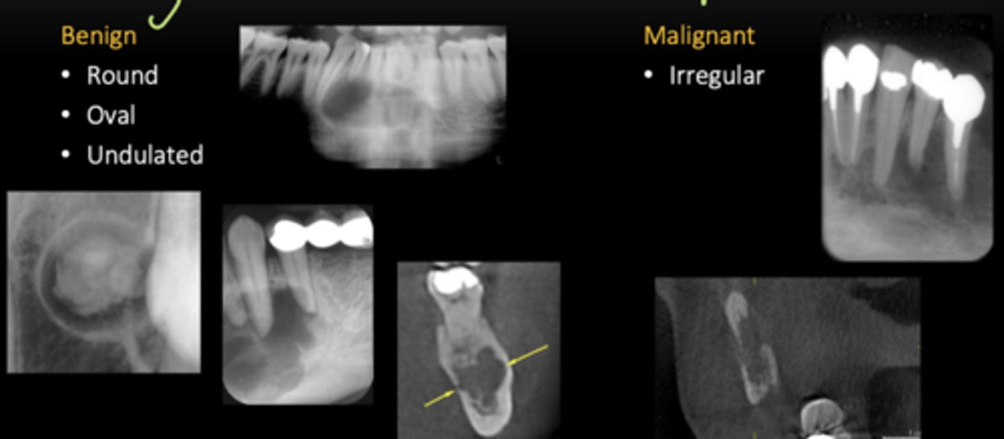 <p>Benign: has some kind of shape</p><p>- round </p><p>- oval </p><p>- undulated </p><p>Malignant: no shape</p><p>- irregular </p>