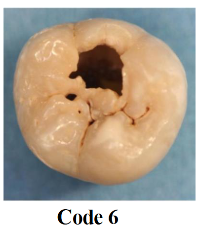 <p>Extensive distinct cavity with visible dentin (deep and wide cavitation)</p>