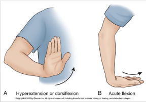 <p>flexion = decreases angle of joint (knee, elbow, wrist)</p><p>extension = increases angle as body parts moves from a flexed to straightened position </p><p>hyperextension = dorsiflexion = extending joint beyond straight/neutral position </p><p>acute = bending joint to max/near max capacity, significantly closing angle of joint </p>