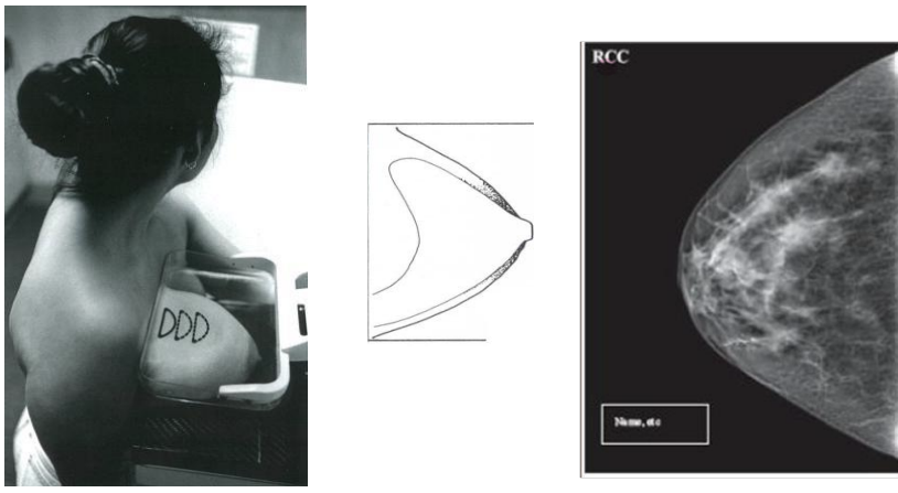 <ul><li><p>Boob is centred in the middle with the nipple in profile</p></li><li><p>Pec muscle seen indicating that the boob has been positioned as far forward</p></li><li><p>Medial and lateral portions of breast seen </p></li><li><p>Well compressed and well exposed </p></li></ul><p></p>