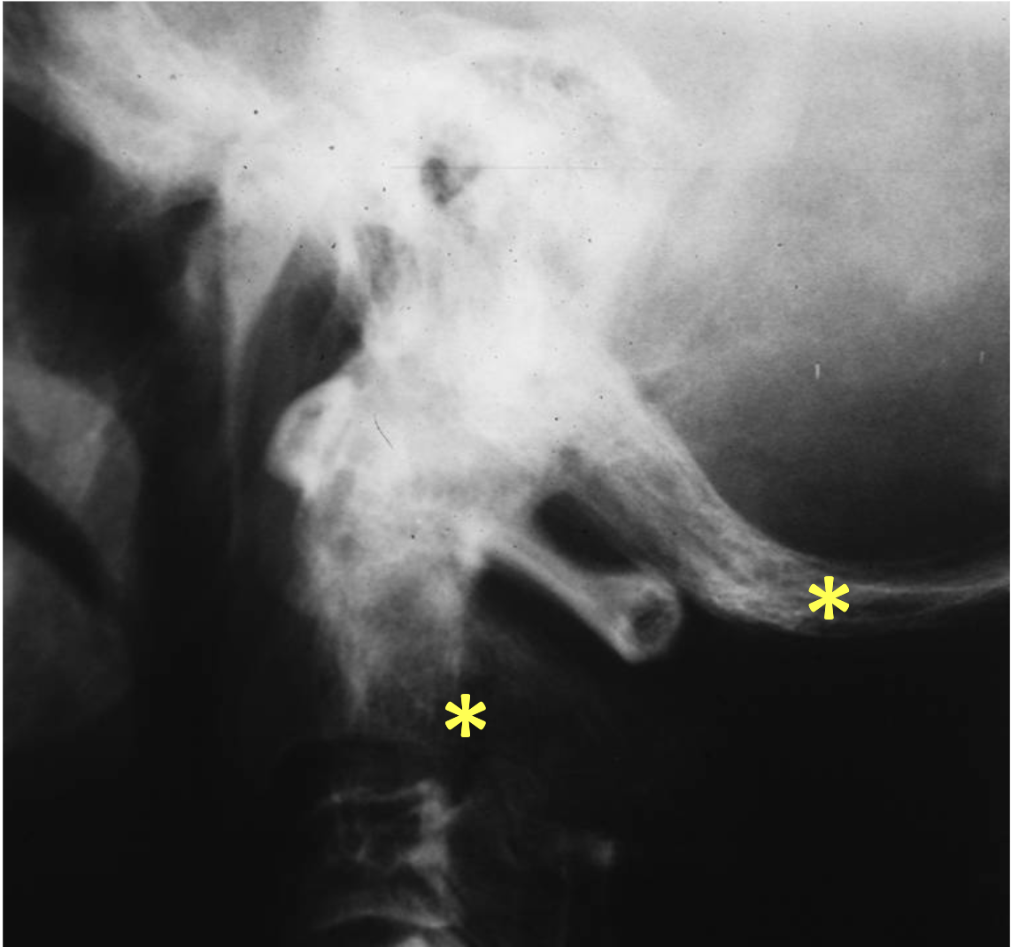 <p>What tumour like disorder is this, where is it?</p>