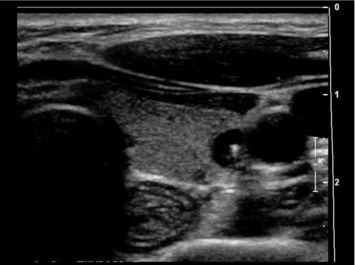 <p>Find the sternocleidomastoid muscle</p>