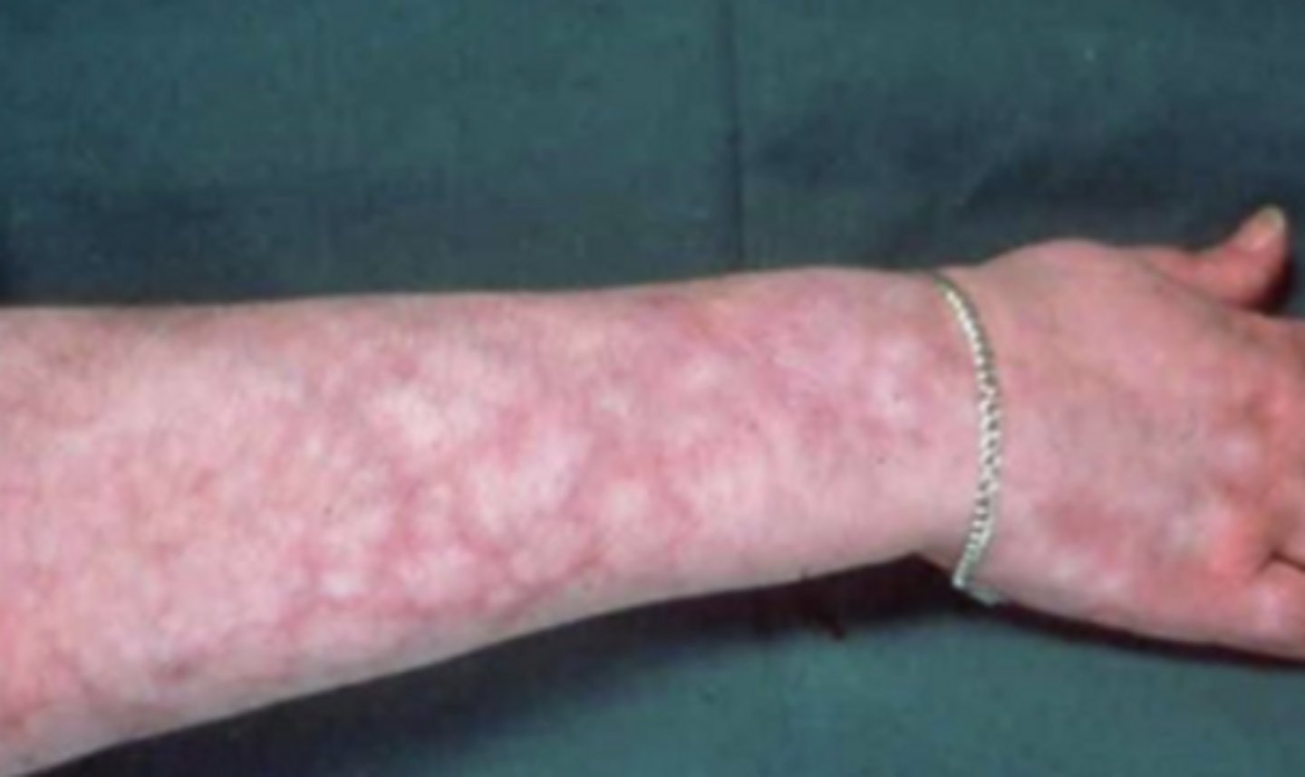 <p>patchy or blotchy discoloration. describes post mortem changes or ischemic changes</p>