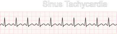<p><span>100-150bpm. rhythm is normal but too fast. workload of the heart is increased while the perfusion is decreased. this is a normal response to the body's increased demand for O2</span></p>