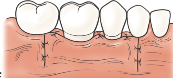 <ol><li><p><span>Internal Bevel incision and vertical releasing incision</span></p></li><li><p><span>Removal of collar of soft tissue following flap elevation</span></p></li><li><p><span>ostectomy</span></p></li><li><p><span>Inspection of final bone contours after ostectomy and osteoplasty</span></p></li><li><p><span>Suturing</span></p><p class="p2"><span>Note that the flap margin is </span><strong><span>displaced in an apical position compared to its original position</span></strong></p></li><li><p class="p2"><span>Placement of periodontal dressing to stabilize the flap at its new position</span></p></li></ol><p></p>