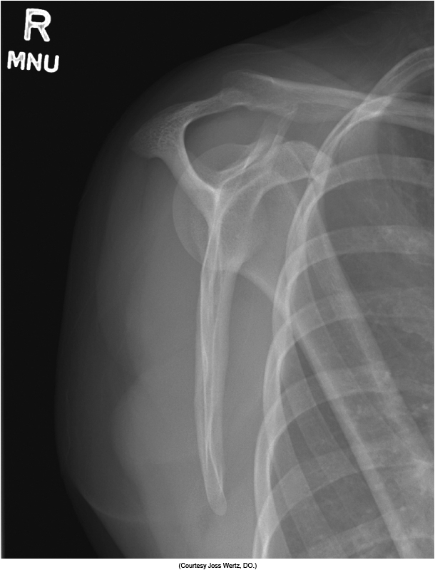 <p>correct rotation is evidenced by humerus should not superimpose the scapula too much, body of scapula should be end on without superimpositionoer ribs, acromion and coracoid process Y </p>