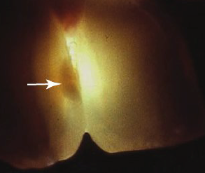 <p><strong>Transillumination</strong></p>