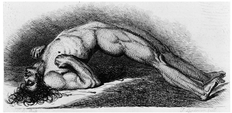 <p>Causative Agent: Clostridium tetani<br>Symptoms/Signs: Uncontrollable clenching of the jaw, arching of the back, flexion of the arms, and extension of the legs.</p>