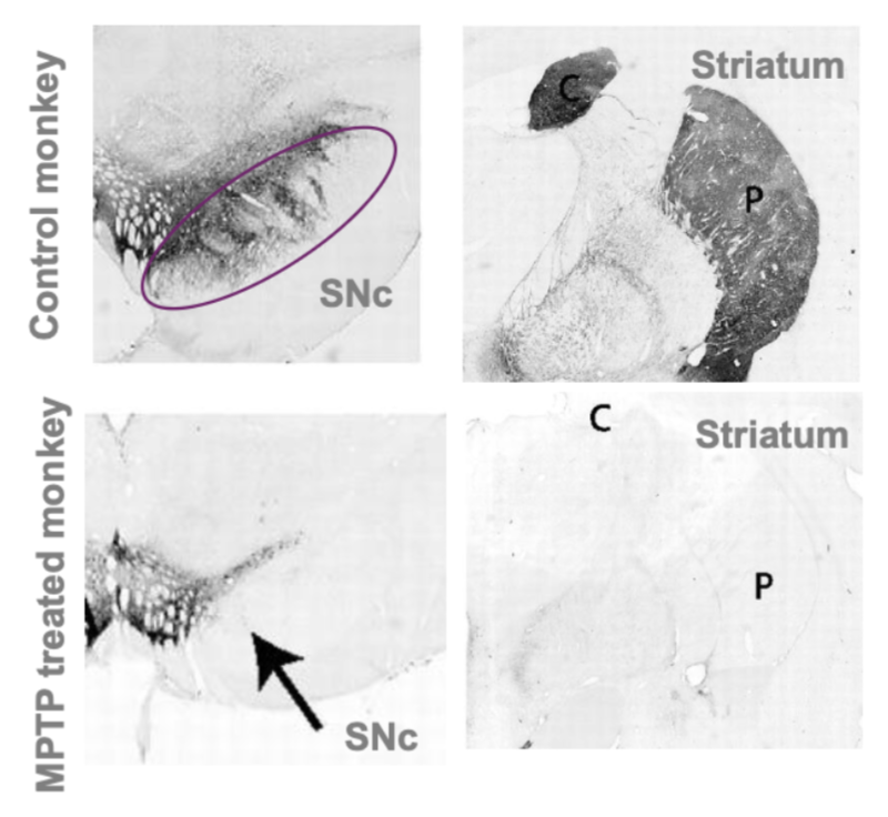 <p>MPTP is an impurity in the synthesis of the opioid desmethylprodine (MPPP)</p><ul><li><p>MPTP selectively ablates dopaminergic neurons in the substantial nigra compacta</p></li></ul><p>In 70s, several young patients presenting with PD-like symptoms as an effect of taking MPPP</p><p>Indicated that MPTP could model PD in animals</p><ul><li><p>these models exhibited akinesia, tremors and termination of dopaminergic neurons in the striatum</p></li></ul><p></p>