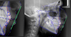 <p>what soft tissue measurement:</p><p>- Lower lip to E-Plane</p><p>- Distance from the most protrusive point on the lower lip to E-Plane along a perpendicular line</p><p>- If L Lip is anterior to E-Plane, the measurement is positive</p><p>- If L Lip is posterior to E-Plane, the measurement is negative</p><p>- Tells you about lower lip protrusion</p>