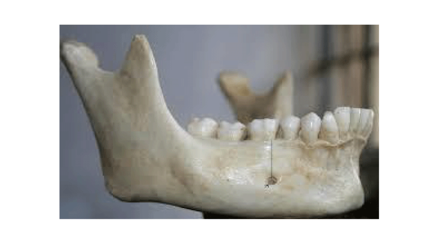 An opening in the mandible near the chin. Clue: mental = chin.