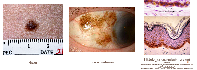 <ul><li><p>Mechanism<span style="font-family: "Gill Sans MT";"><strong>: </strong>brown-black pigment formed by melanocytes and transferred to keratinocytes</span></p><ul><li><p><span style="font-family: "Gill Sans MT";">Function is to prevent the harmful effects of ultraviolet (UV) light</span></p></li></ul></li><li><p><span style="font-family: "Gill Sans MT";"><strong>Organs affected: </strong>skin, eye</span></p></li><li><p><strong>Gross & microscopic morphology: </strong>brown–black pigment</p></li></ul><p></p>