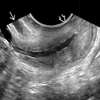 <p>is this normal or cervical incompetence?</p>