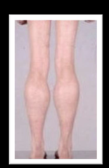 <p>Affected muscle fibers are replaced with fat and connective tissue --> increased size of corresponding muscles</p>