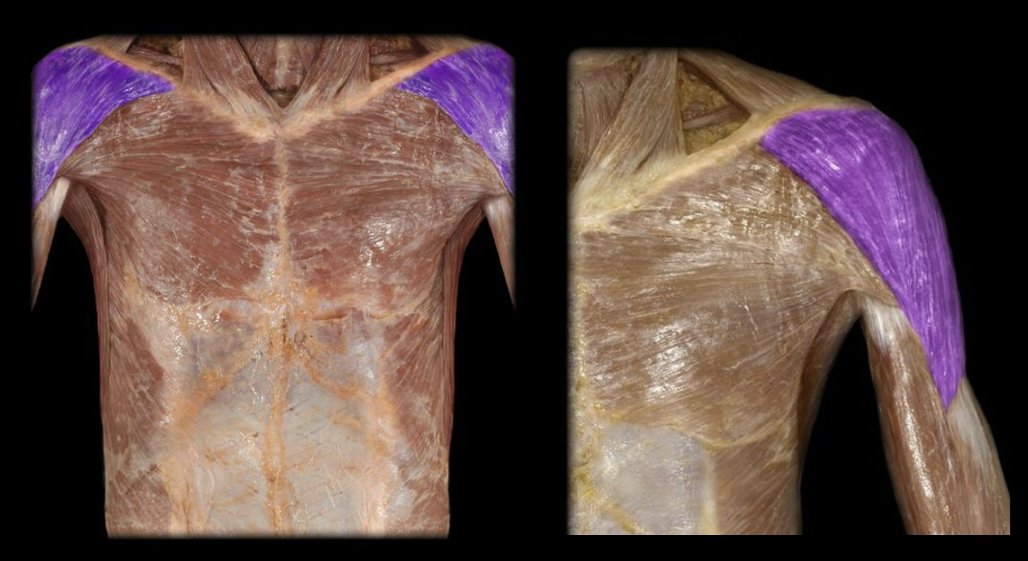 <p>Top of Shoulder</p>