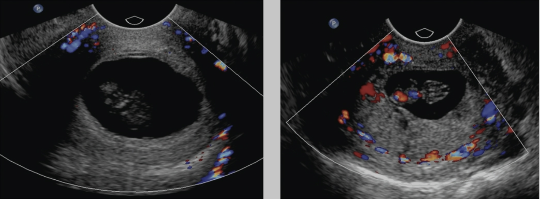 <p>A sonographic technique that can assist in determining if a gestation is an abortion in progress versus a cervical pregnancy or cesarean scar pregnancy is:</p><ul><li><p>graded compression</p></li><li><p>the abdominal approach</p></li><li><p>color Doppler</p></li><li><p>low resistive index</p></li></ul><p></p>