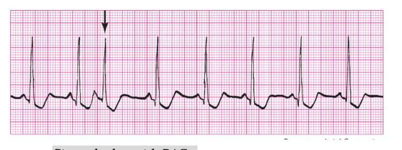 <p><span style="background-color: transparent;"><strong>Rules for Premature Atrial Complex</strong></span></p>