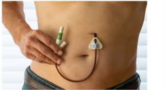 <p>is inserted through the abdominal wall (through a surgically created opening) into the stomach</p>
