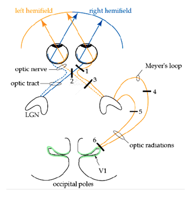 <p>lesion to optic chiasm + potential cause</p>