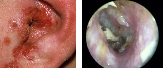 <p>Swimmer’s Ear</p><ul><li><p>Location: Ear canal </p></li><li><p>Symptoms: Red, itchy, discharge</p></li><li><p>Causes: Bacterial, fungal, viral</p><ul><li><p>Pseudomonas aeruginosa</p></li><li><p>Aspergillus sp. </p></li></ul></li></ul><p></p>