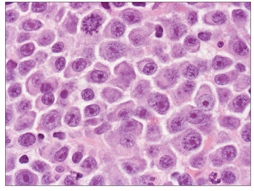 <p>Bone Marrow Trephine</p>