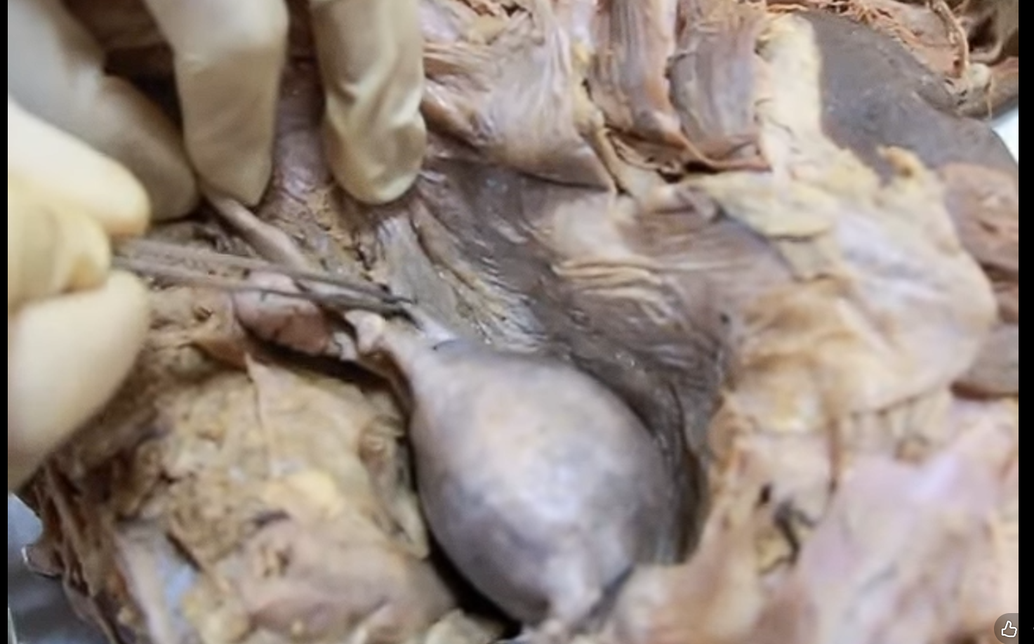 <p>below and in front of uterine tube. within that bulge</p>