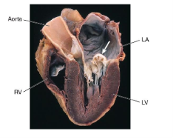 <p>What is mitral valve prolapse (MVP)?</p>